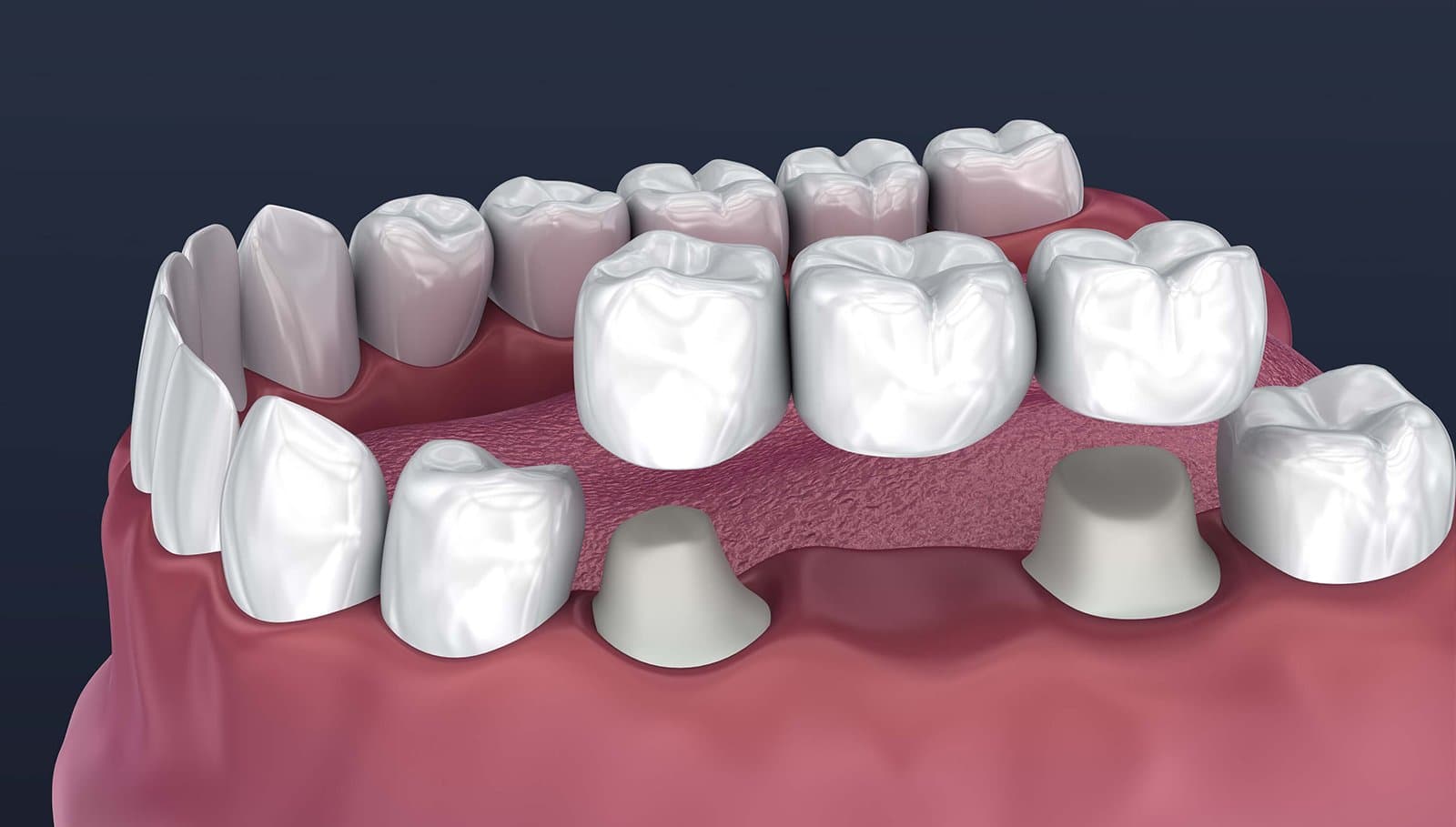 Fixed Dental Bridges – Clean Bite Dentistry
