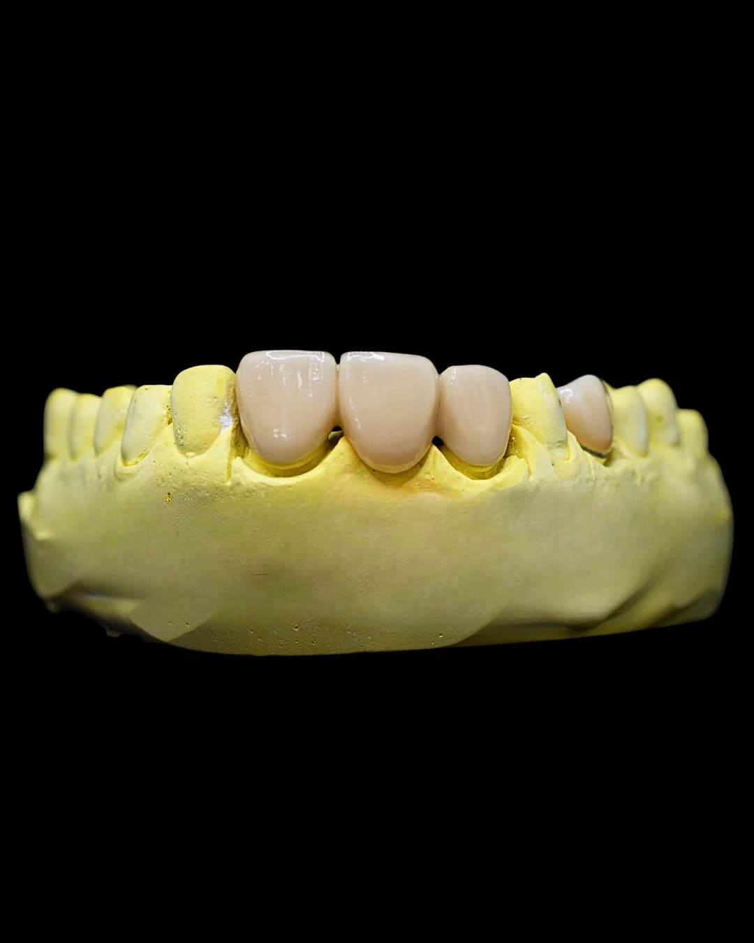 PFM (Porcelain Fused to Metal) - FOCUS Dental Lab