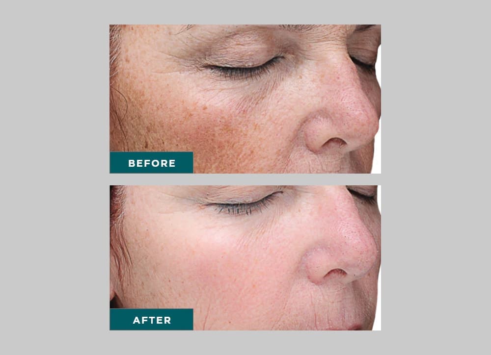 Advanced Skin Peels at Minneapolis Skin Clinic | Twin Cities Peels
