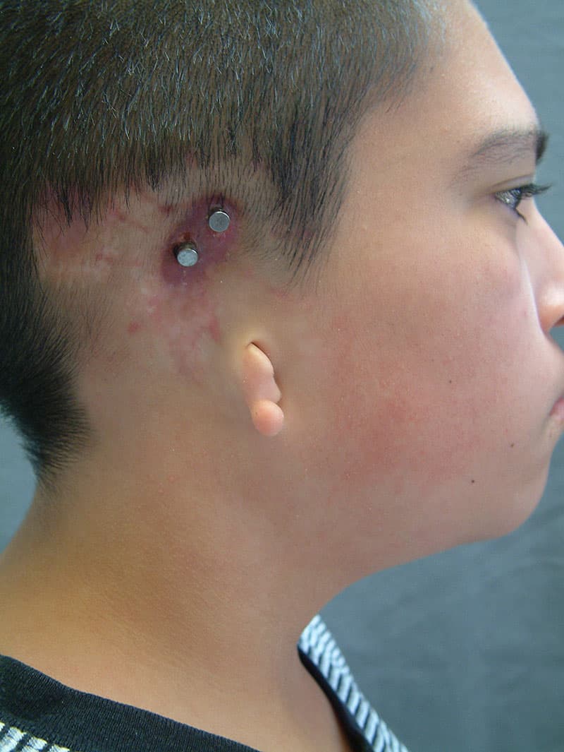 Auricular (ear) prosthesis | Personalized Prosthetics | Colette Shrader ...