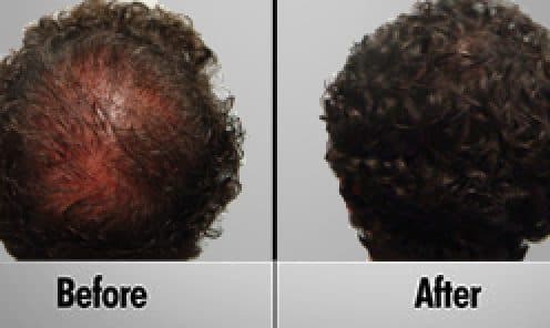 Platelet Rich Plasma Treatment Toronto | Sure Hair International | Hair ...