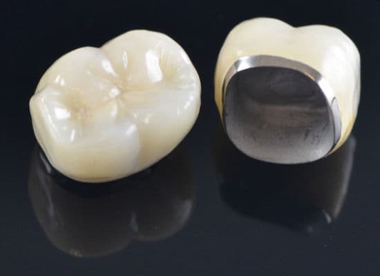 Porcelain Fused To Metal Crown Before And After