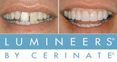 Porcelain Veneers and Lumineers by Dental Smile Pattaya