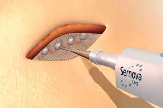 Sernova touts data on cell pouch for treating insulin-dependent diabetes