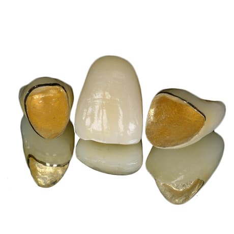 Porcelain-Fused-to-Metal (PFM) Crowns | Dental Lab Manufacturers ...