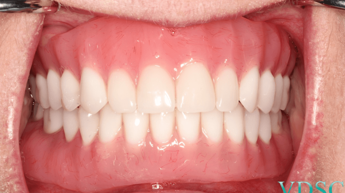 Process for Getting Immediate Dentures – Newark67.Com
