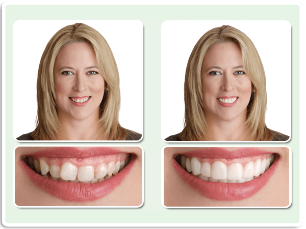 Snap-on Instant Smile | Snap-on Dallas - Prestonwood Dental ...