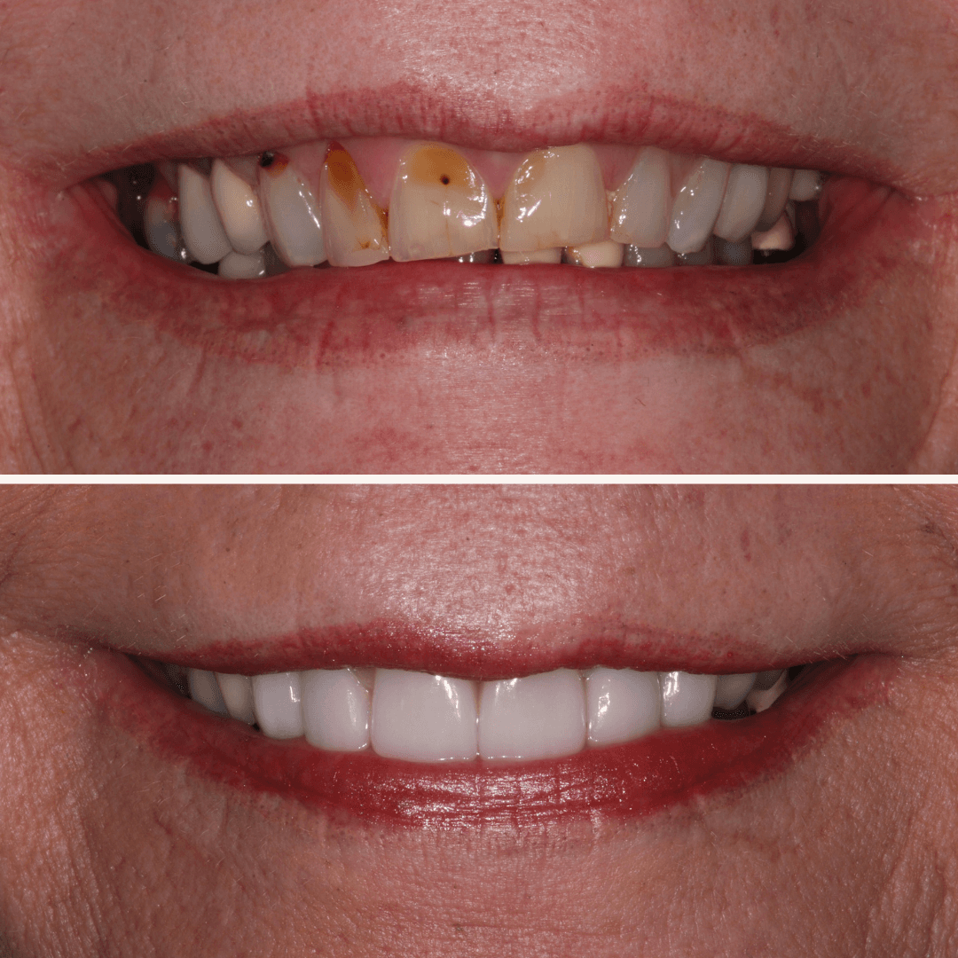 Porcelain Veneers - Elite Smiles in Draper, UT