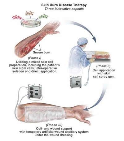 Burn Therapy: A Regenerative Medicine Approach - Regenerative Medicine ...