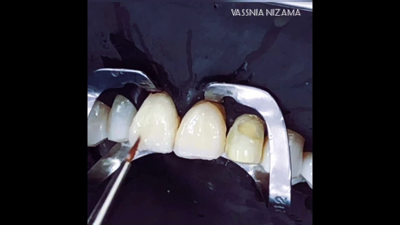 Direct veneer with preheated Micerium composite by Vassnia Nizama - YouTube