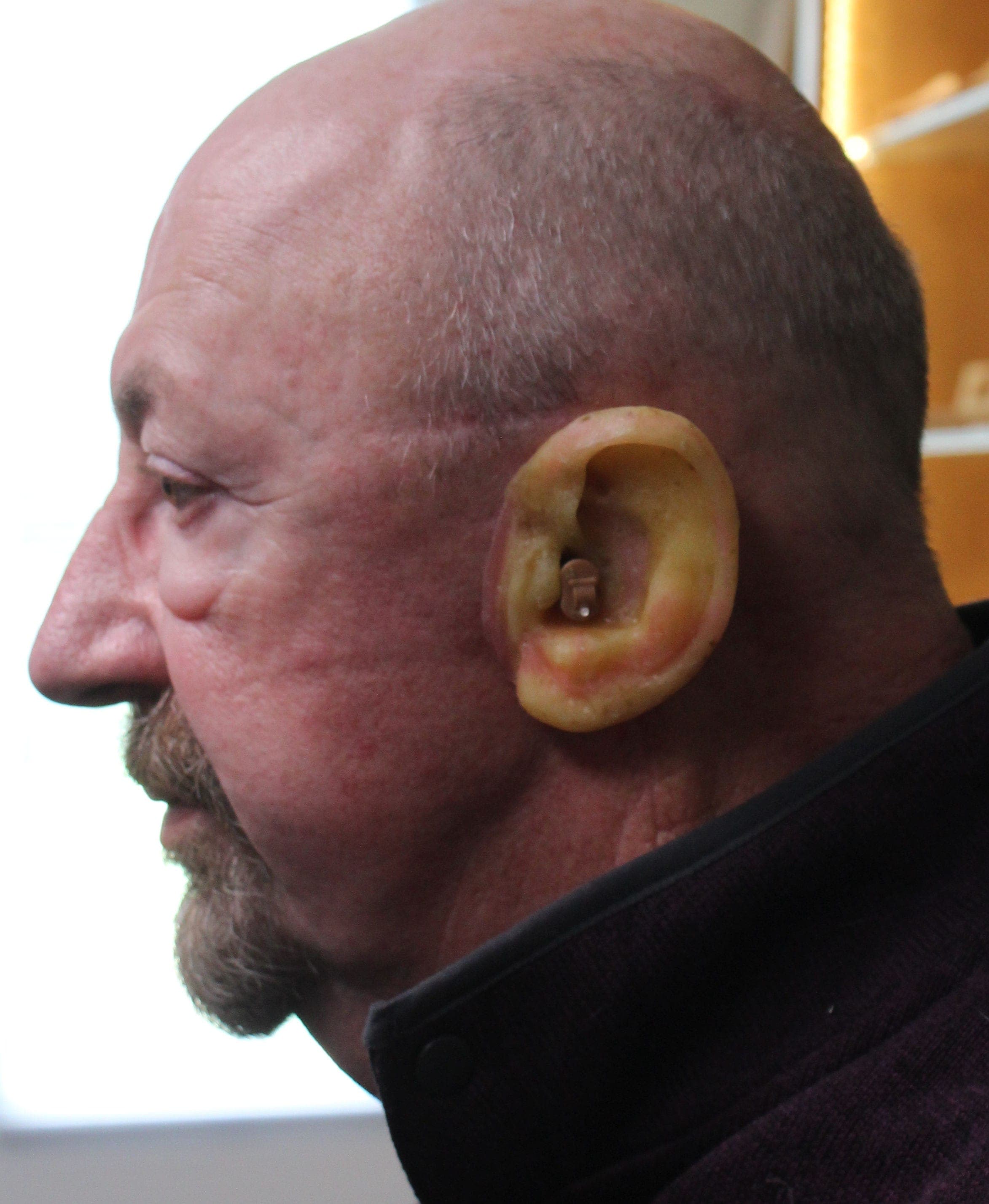 Auricular/ear prosthetics are hand sculpted and hand made for each patient