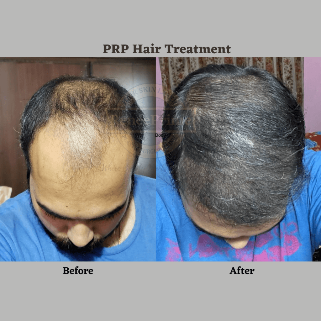 PRP Hair Treatment for Hair Growth - Natural with No Side Effects ...