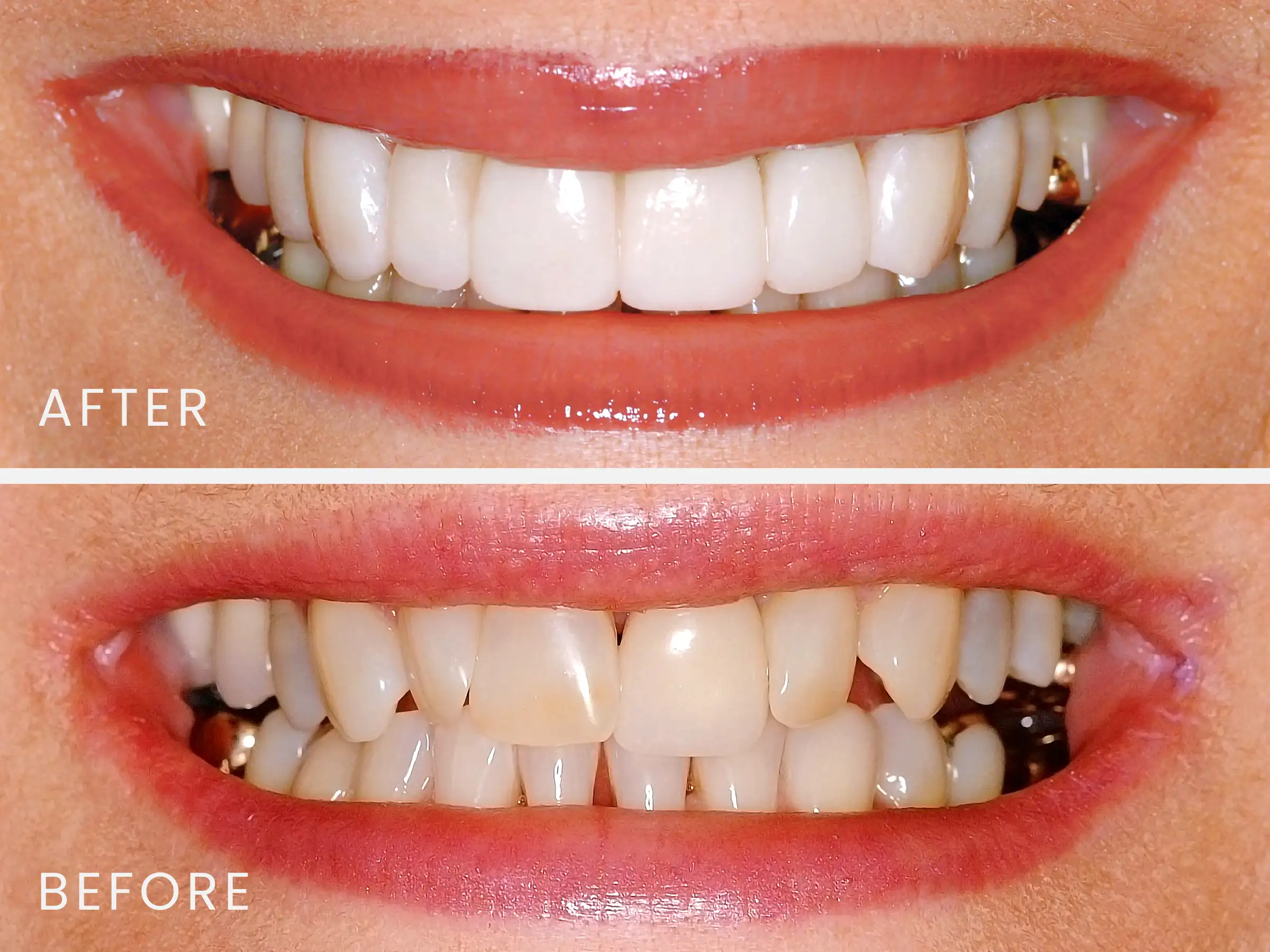 Lumineers® Dental Veneers - Smiles on Clark Dentistry in Orcutt, CA