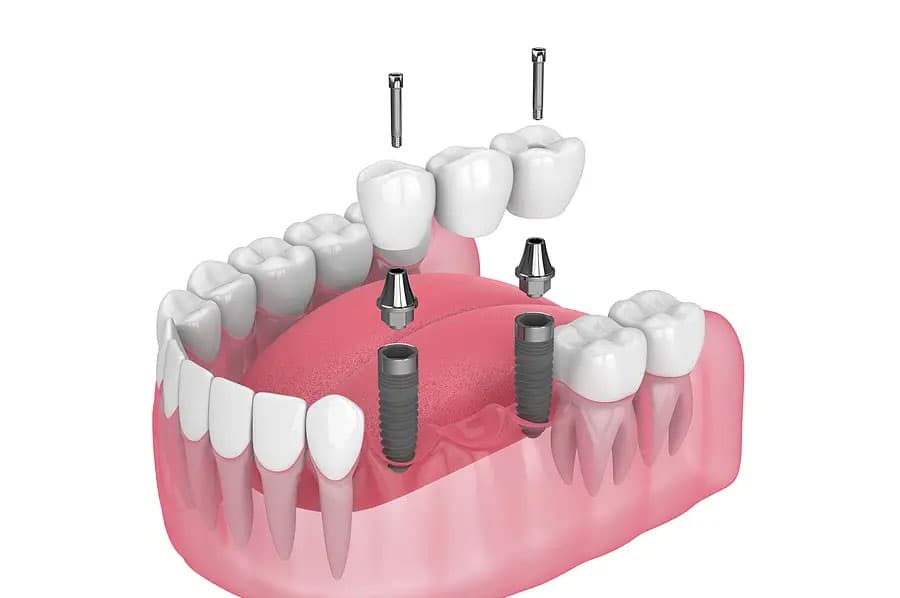 Cantilever Bridge Dental