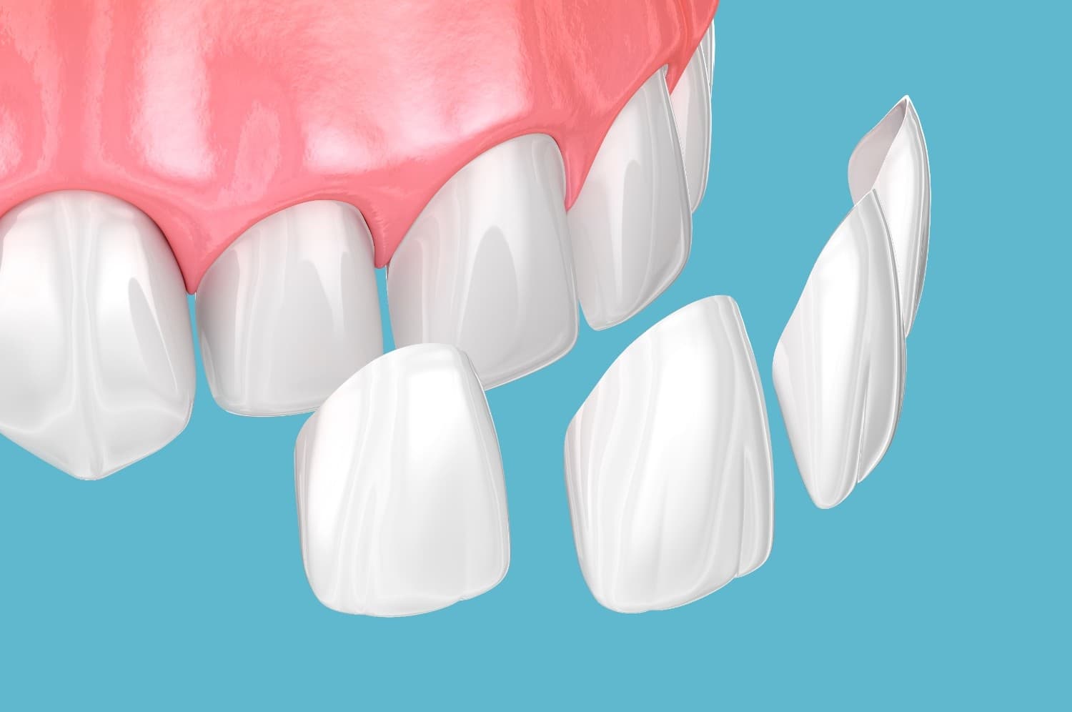 Dental Veneers Liverpool | Porcelain & Composite Options