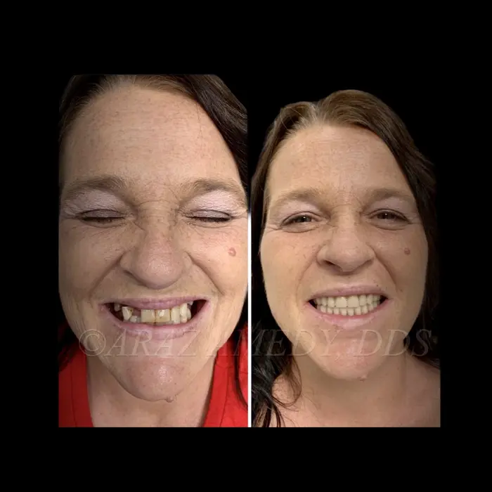 Immediate Dentures — NASHVILLE DENTURES AND IMPLANTS